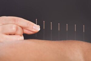 Acupuncture Therapy is effective